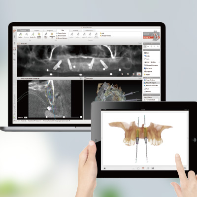 CAM義齒制作實(shí)現(xiàn)即刻修復(fù)