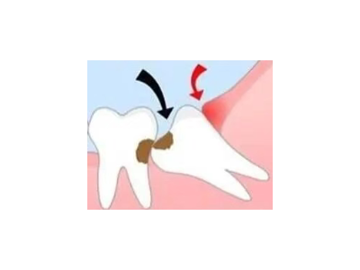 吃完飯后老塞牙？別大意！這可能是你的牙齒在報警