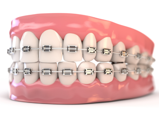 口腔正畸中常見(jiàn)的七個(gè)誤區(qū)