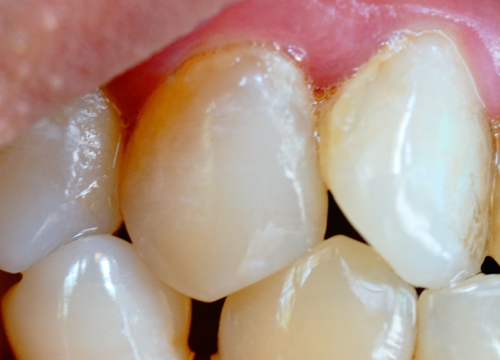 牙齒表面的牙釉質(zhì)掉了還可以修復(fù)嗎？