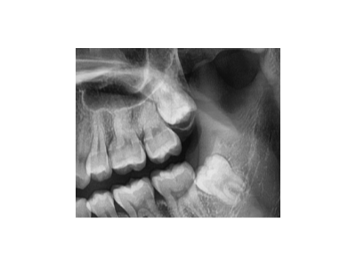 既然「智齒」不宜久留，為什么不能一次性拔掉？