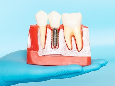 種牙VS鑲牙，你適合哪種?