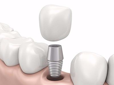 在承德哪家口腔醫(yī)院口腔種植齒好一點，惟德口腔醫(yī)院值得您的選擇