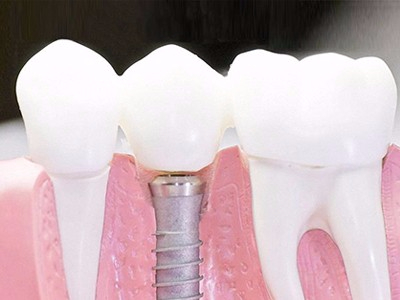 在承德口腔種植齒需要多少錢(qián)？惟德口腔一一為您道來(lái)