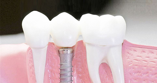 在承德口腔種植牙齒需要多少錢(qián)？惟德口腔一一為您道來(lái)